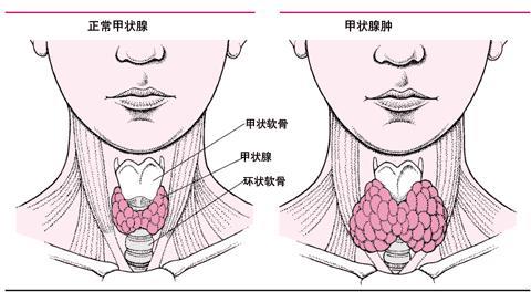 切除半边甲状腺后,对身体影响多大呢(切除半边甲状腺的危害)