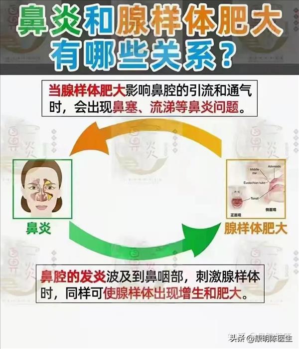 腺样体肥大和鼻炎、鼻窦炎有没有关系？(腺样体肥大和鼻炎有关系吗)