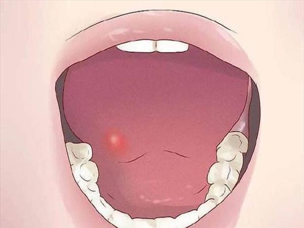 舌头上为什么会有口腔溃疡(扩展：为什么会有口腔溃疡舌头)